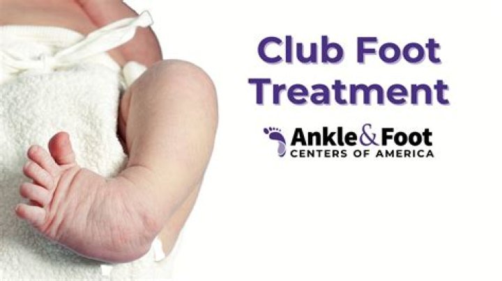 Does clubfoot go away?